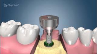 Dental Implant Procedure - Two Stage  🦷  Award Winning Patient Education