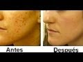COMO ELIMINAR EL ACNE Y SUS MARCAS. RAPIDO Y DEFINITIVAMENTE. MI EXPERIENCIA.