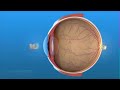 Implant de cataracte  cristallin artificiel