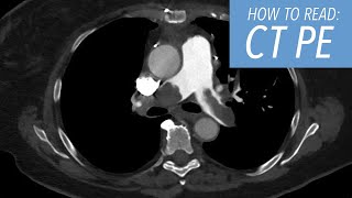 How to Read a CTA of the Chest Pulmonary Embolism Protocol