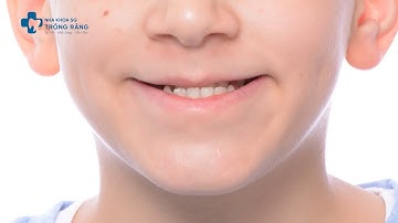 Kết quả niềng răng móm | Trước và sau khi niềng răng móm