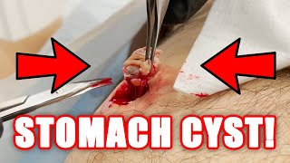 STOMACH CYST!