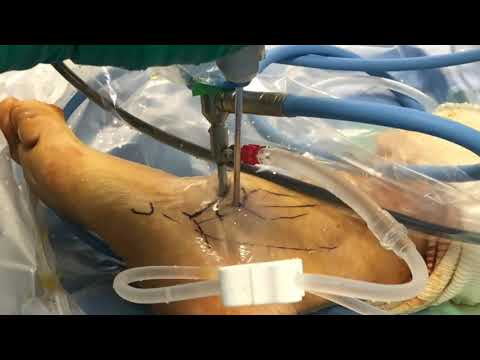 Anterolateral Arthroscopic Posterior Subtalar Arthrodesis: The Surgical Technique
