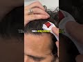 How to use the Derma Roller for Hair Loss