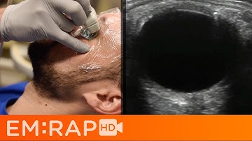 Ultrasound of Retinal vs Vitreous Detachment