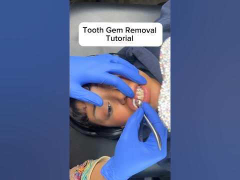 Tooth Gem Removal Tutorial - Quick & East #toothgems #grillz #