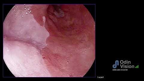 ONM Final AI and Barrett