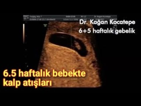 6 5 haftalik gebelikte bebegin kalp atislarinin gorulmesi ve duyulmasi youtube