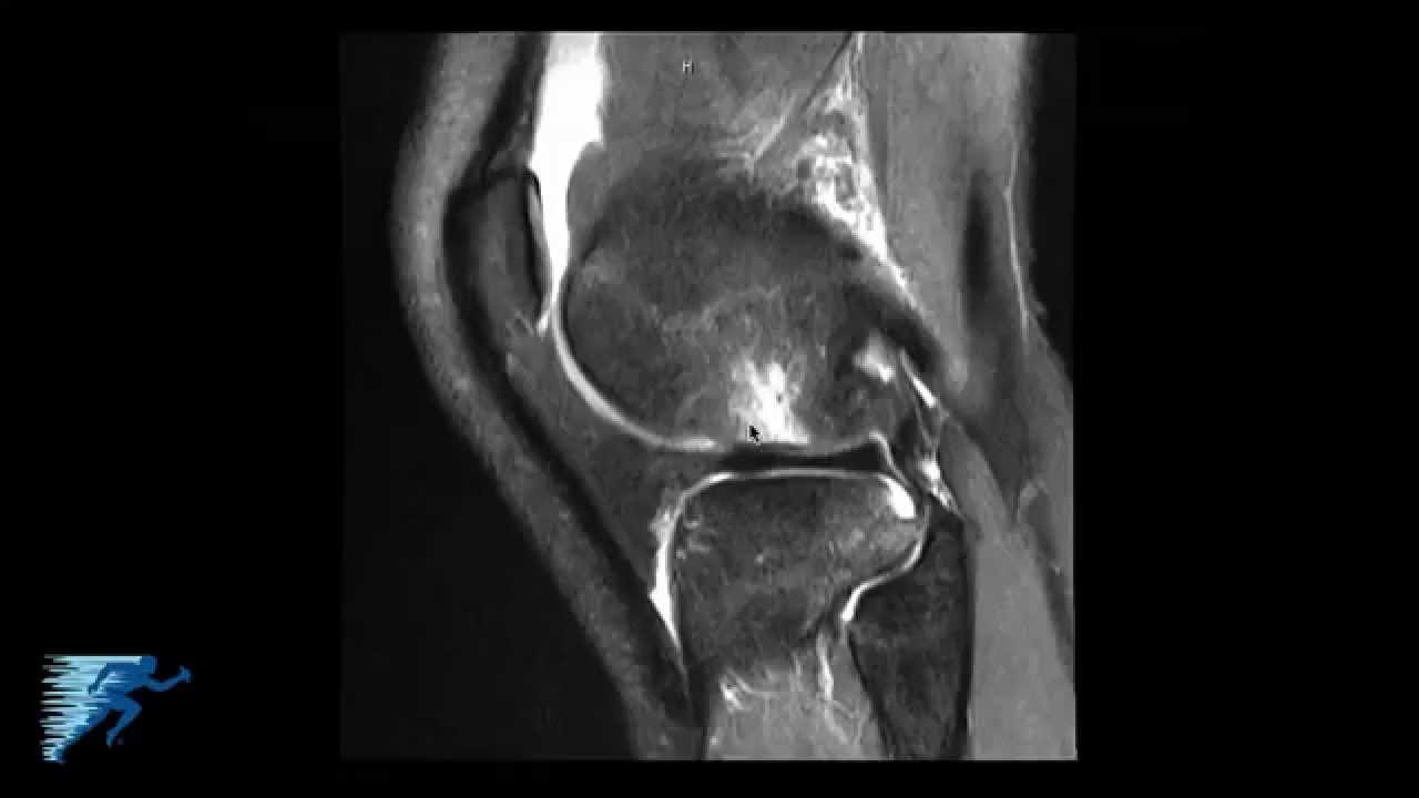MRI reveals torn ligament in left knee of Knicks' Kristaps Porzingis
