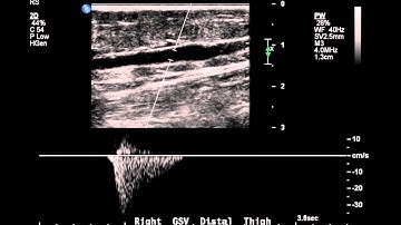 Venous Insufficiency Exam - Case Study