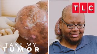 Arlin's Excited and Relived to Remove His Tumor | Take My Tumor | TLC