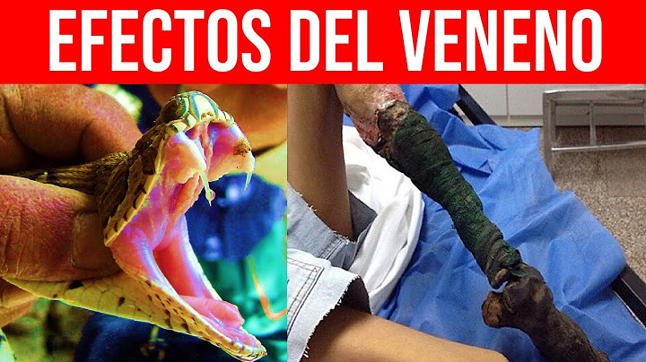 ¿Qué Pasa en tu Cuerpo si te Muerde una Serpiente? Emponzoñamiento Ofídico Parte 2 | Mentes Médicas