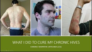 What I Did to Cure my Chronic Idiopathic Urticaria (Chronic Hives)