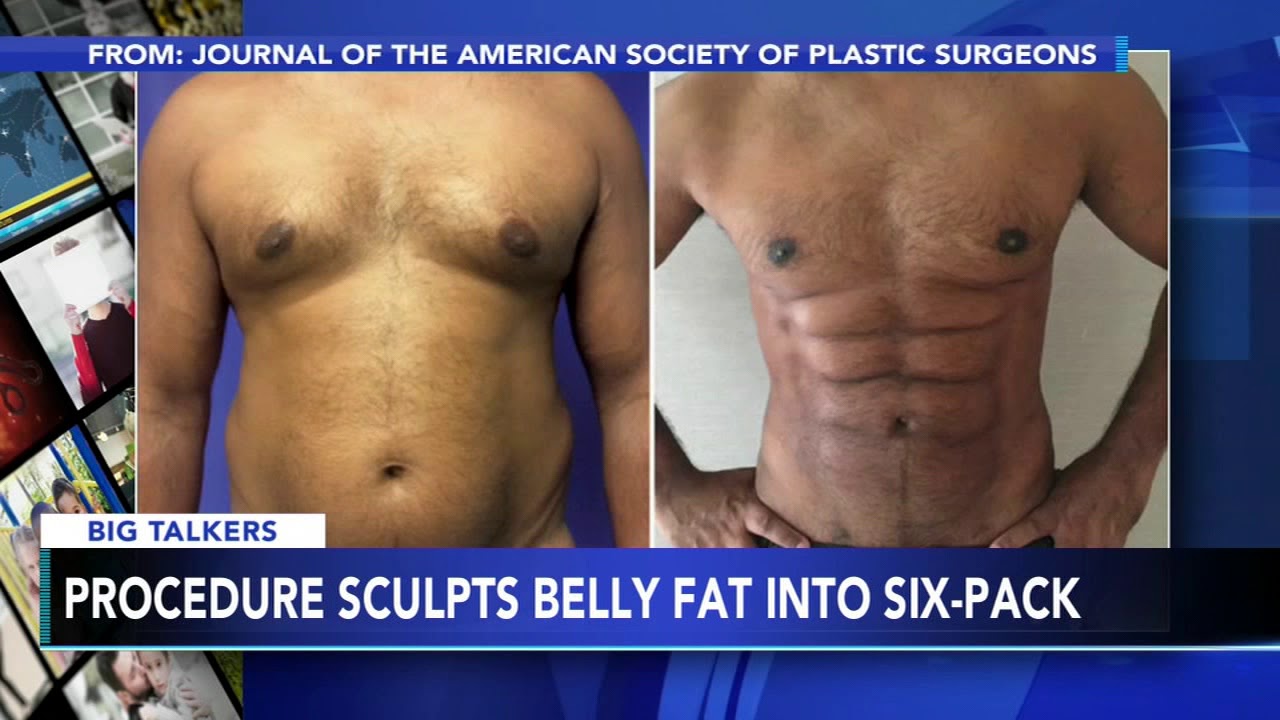 ⁣New procedure uses foam to sculpt belly fat into 6-pack abs
