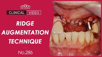 Ridge augmentation using Bone Tack & InnoOss-B [Dr. Jeon Inseong]