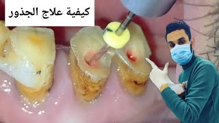 كيفية تنظيف عصب جذور الاسنان وحشو العصب|| Root canal rotary Endodontics