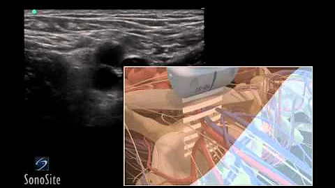 How To: Ultrasound Guided Insertion of a Femoral Vein Catheter 3D Video