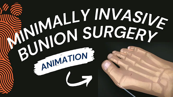 Minimally Invasive Bunion Surgery: A Short Animation