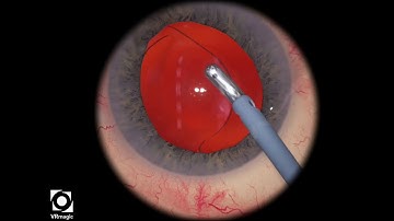 EyeSi CAT B IOL Insertion, Level 1 (spheric IOL inserted, remove viscoelastic)