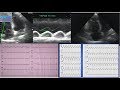 Arrhythmogenic right ventricular cardiomyopathy ARVC or ARVD. A case. ECG and echocardiography