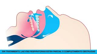 Silent Nite para pacientes