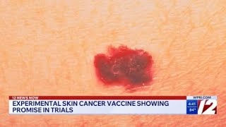 Moderna, Merck mRNA cancer vaccine prevents melanoma from returning in trial