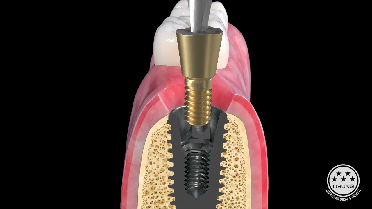 OSUNG remover full kit (ORFKit)