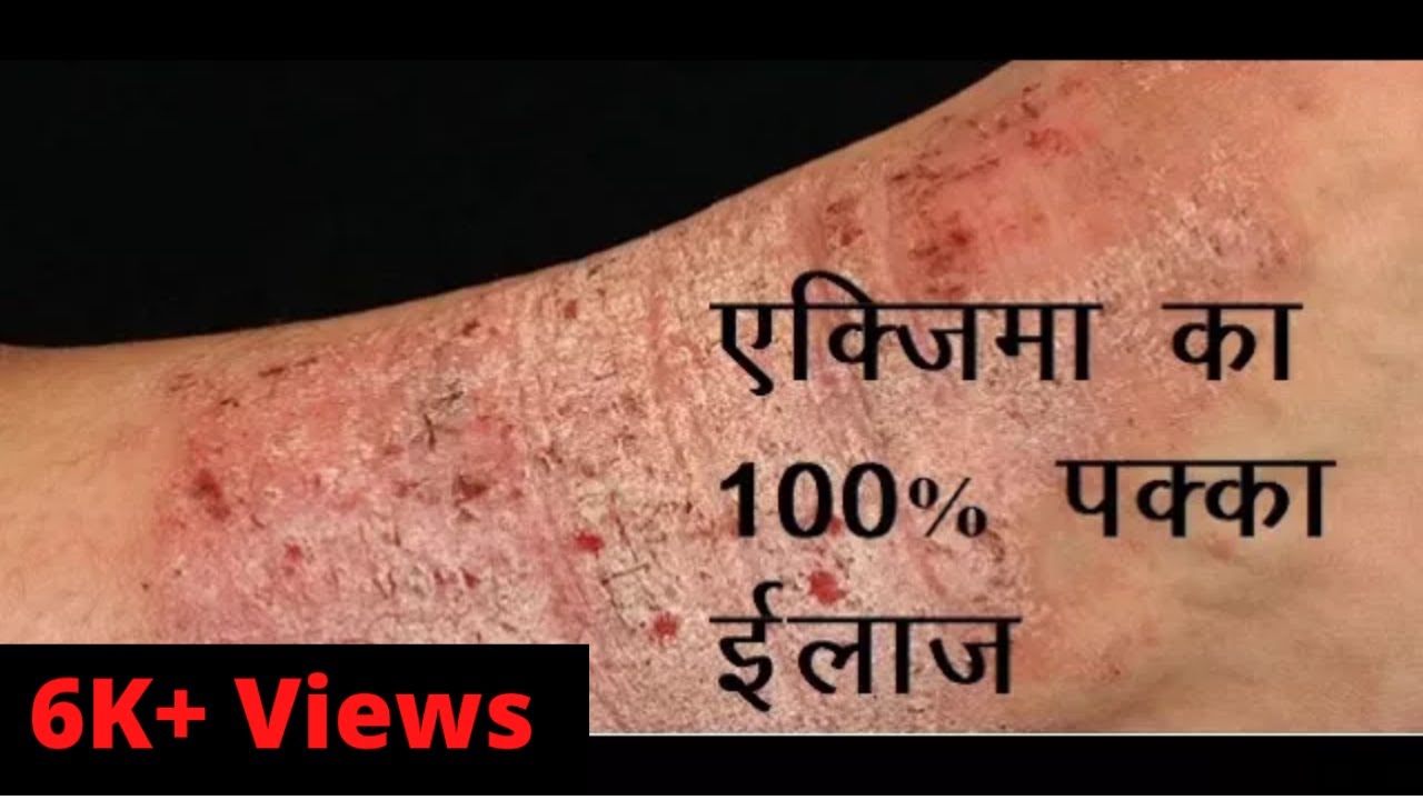 eczema Treatment Home Remedies 100 cure remedy SURBHI UTPAD YouTube