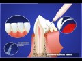 Снятие зубных отложений при помощи ультразвукового скалера
