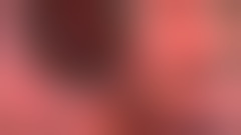 Crystalens Z syndrome: CTR placement followed by IOL Exchange by Steven G. Safran MD