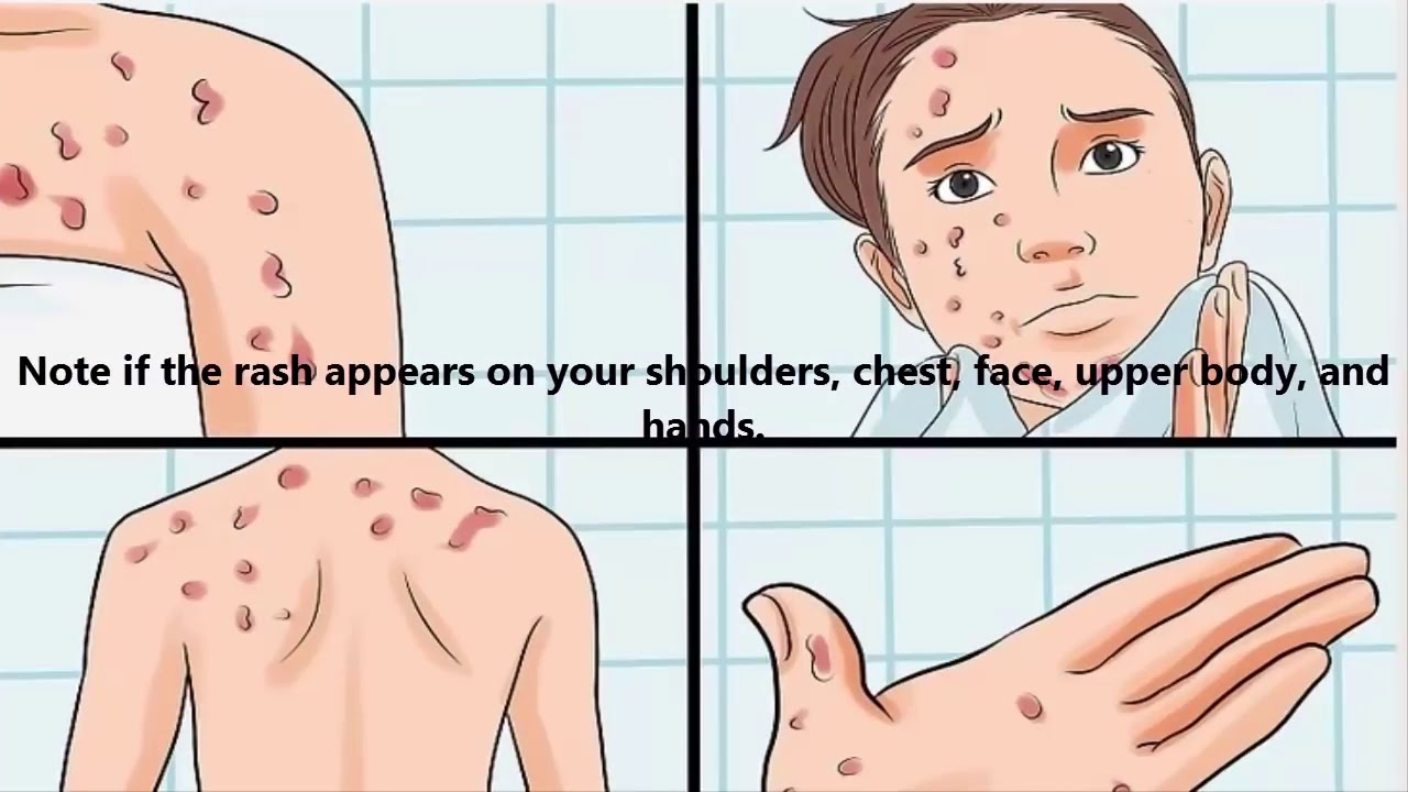How to Identify an HIV Rash - YouTube