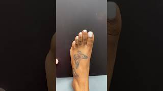 Celebrity MINIMALLY INVASIVE TOE SHORTENING SURGERY ❤️‍🩹#shorts #toeshorteningsurgery #toeshortening Wealth