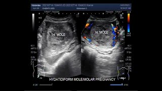 Complete Hydatidiform Mole, also called Molar Pregnancy.