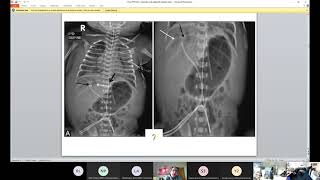 Central Line Care in Neonates