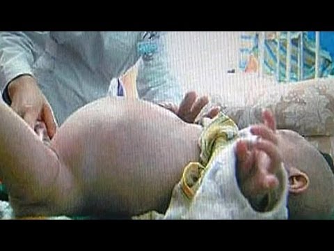 'Pregnant' Two-Year-Old Boy Gives 'Birth' To Unborn Twin ...