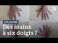 Six doigts à chaque main : une étude se penche sur la polydactylie