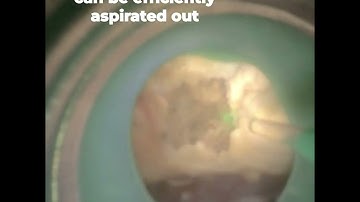 Flexible a ureteroscopy with Flexible access sheath with suction (FANS)