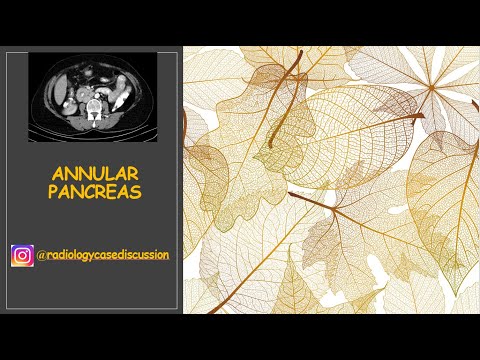 20 . CT imaging of Annular Pancreas(Annüler Pankreas BT Bulguları)