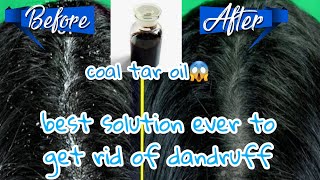 How to get rid of dandruff faster//تخلصي نهائيا من قشرة الرأس بوصفة فعالة و مجربة في أسبوع فقط 