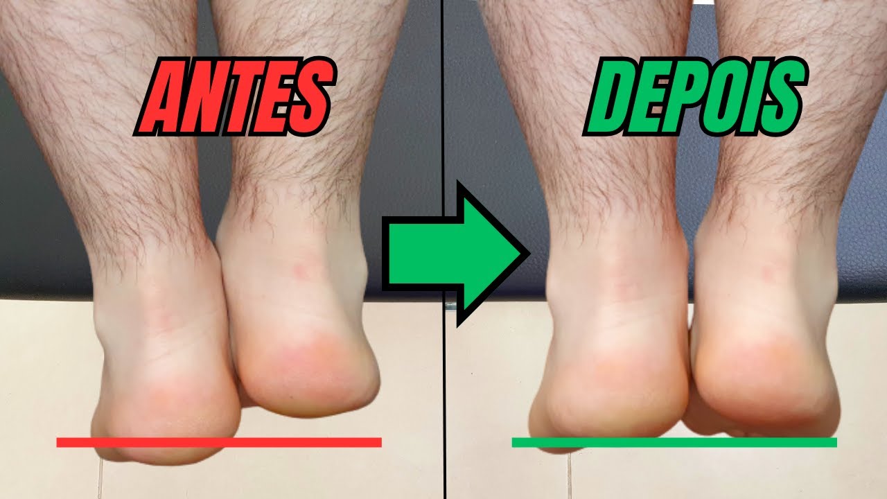 ASSISTA ESSE VÍDEO SE VOCÊ TEM UMA PERNA MAIS CURTA QUE A OUTRA - YouTube