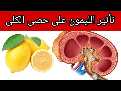 تاثير الليمون على حصى الكلى