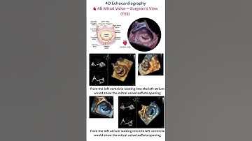 4D Mitral Valve — Surgeon’s View (TEE)   #4DEcho #TEE #MitralValve #SurgeonsView #CardiacImaging