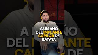 Se cumple un año del implante capilar de @batatapiquard