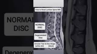 Lumbar Spine Mri