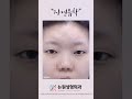 말안하면 아무도 몰라! 자연스러운 쌍꺼풀 #자연유착 #쌍꺼풀수술 잘하는 #부산성형외과