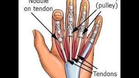 Trigger Finger Release | Ultrasound guided trigger release | Dr. Marc Gruner | Washington D.C.