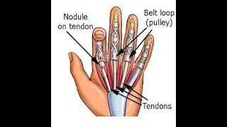 Trigger Finger Release | Ultrasound guided trigger release | Dr. Marc Gruner | Washington D.C.