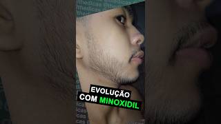 Antes E Depois Minoxidil 7 Meses De Tratamento