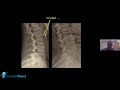 HOW TO EXPLAIN ROTATOR CUFF PAIN &amp; TEARS TO PATIENTS, IN A VERY SIMPLE WAY