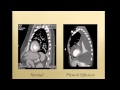 Thoracentesis